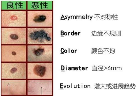 好痣顏色|如何分辨好壞痣？有「這5大變化」別拖...變黑色素瘤。